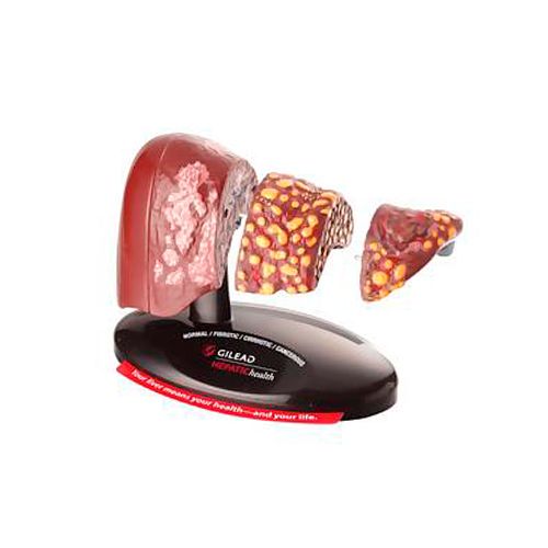 Модель "Печень 4-стадии" / Медицинская мебель